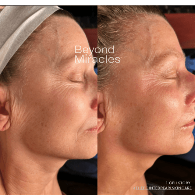 CELLSTORY Glass Skin- 4 sessions at The Barrier Babe Skin Studio in Dallas, TX