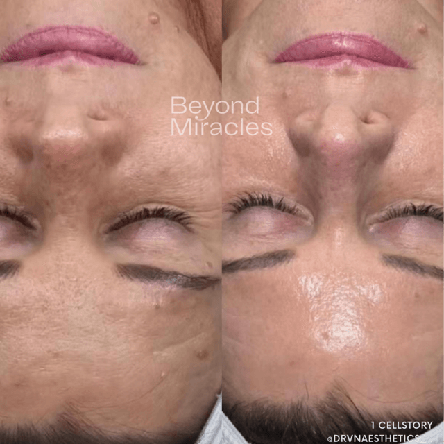 CELLSTORY Glass Skin- 6 sessions at The Barrier Babe Skin Studio in Dallas, TX
